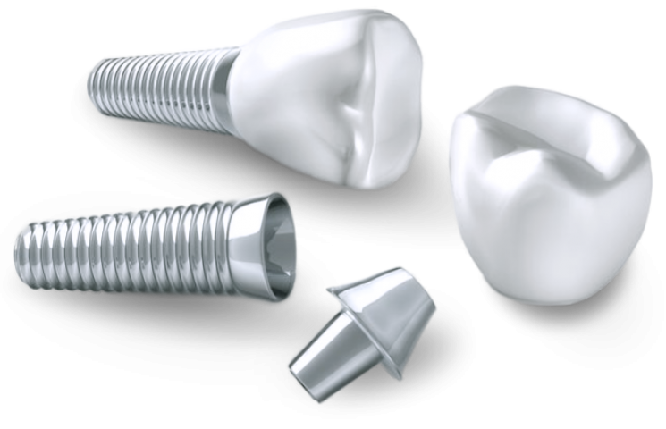 Explant / Dental Implant Removal - Leading Implant Centers